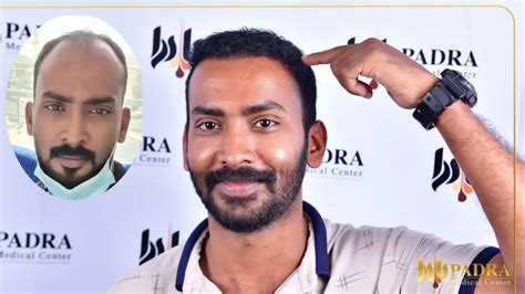 padra clinic hair transplant cost